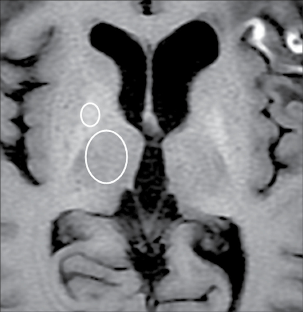 MR images in 45-year-old woman with glioblastoma MR images in 45-year-old woman with glioblastoma